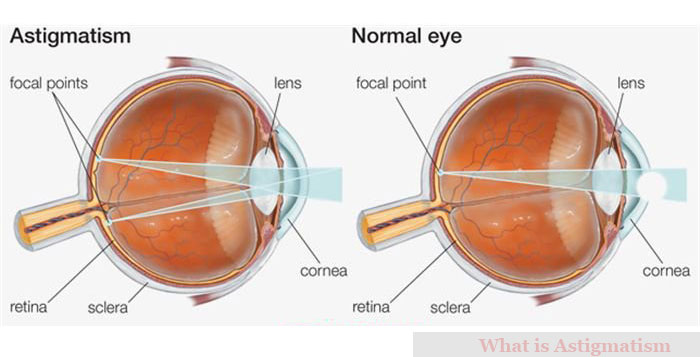 Learning the Basics of Astigmatism, Symptoms and It’s Treatment ...