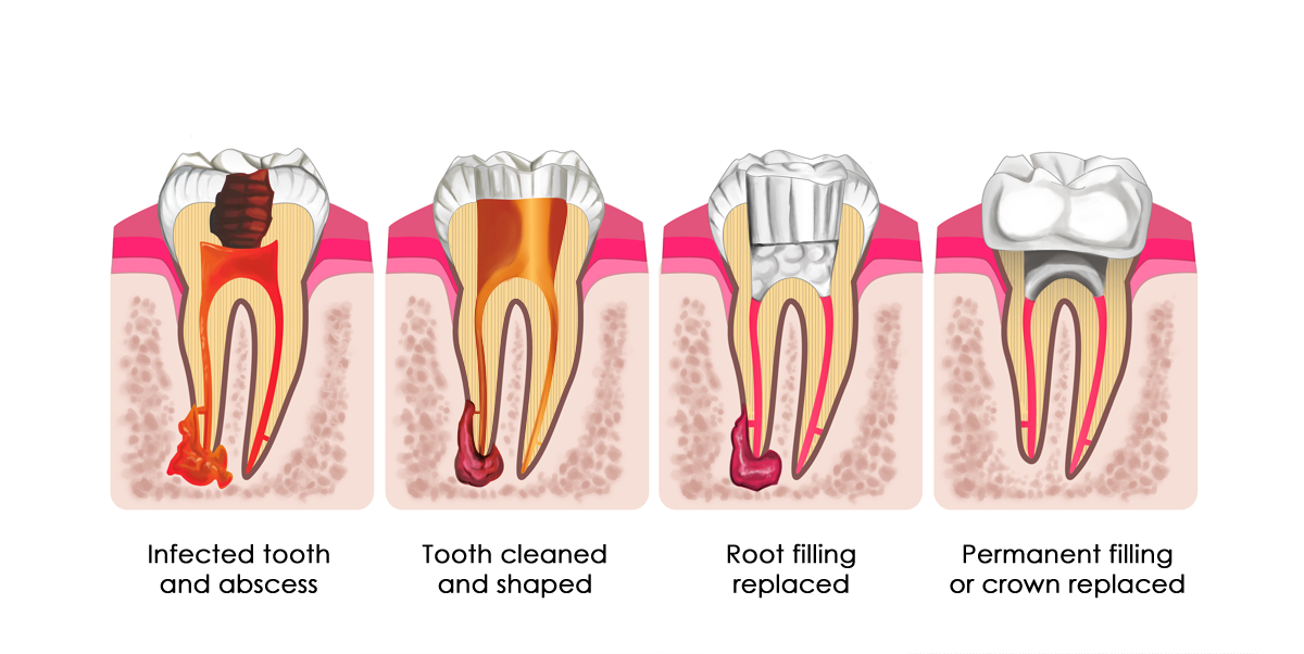 stages-of-root-canal-treatment-articlecube