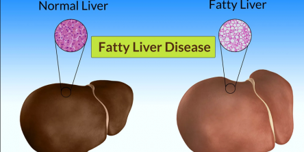 fatty liver