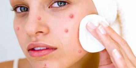 Get Rid of Pimple Mark Naturally