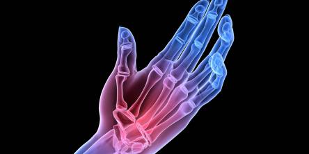 Everything You Should Know About Rheumatoid Arthritis