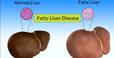 fatty liver