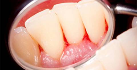 5 Facts About Gingivitis